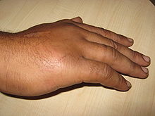 oedème de la main
